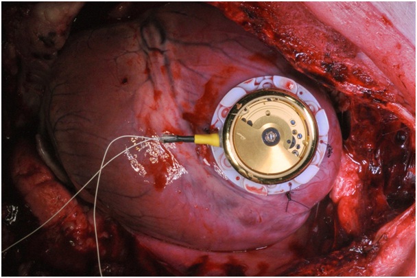 World's first cardiac pacemaker with automatic watch movement