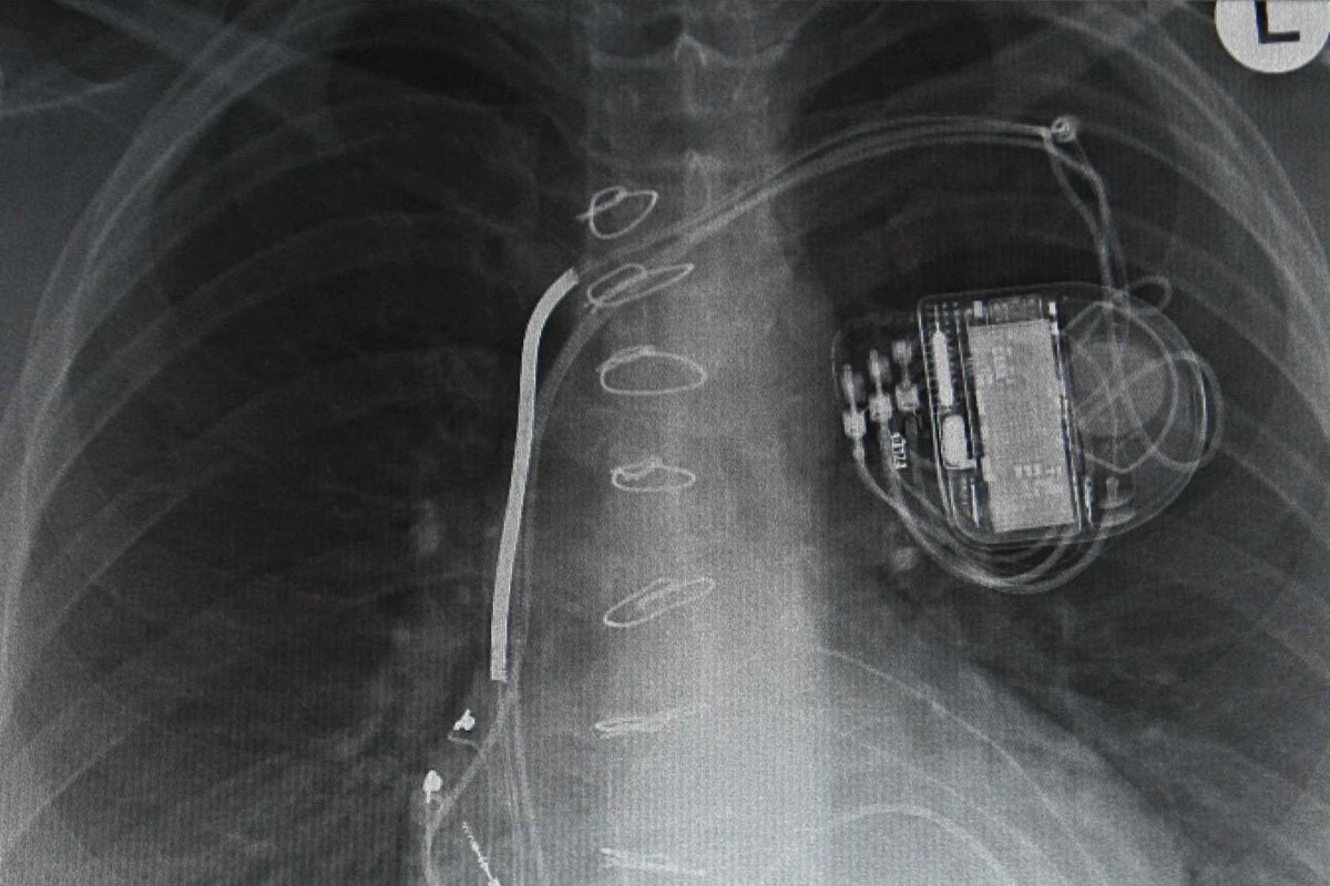 World's first cardiac pacemaker xray